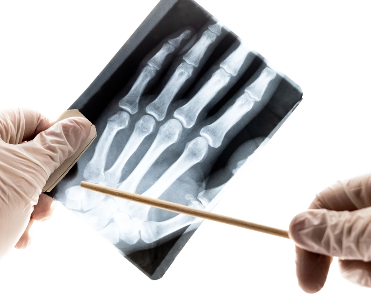 Analysis of radiographic data from patients with rheumatoid arthritis ...